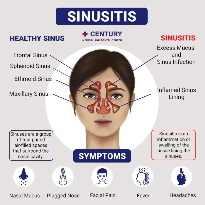 Sinusitis.jpg