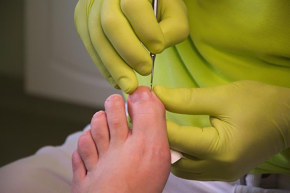 ingrowntoenails_img.jpg