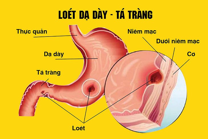 Viem-loet-da-day-ta-trang-1.jpg