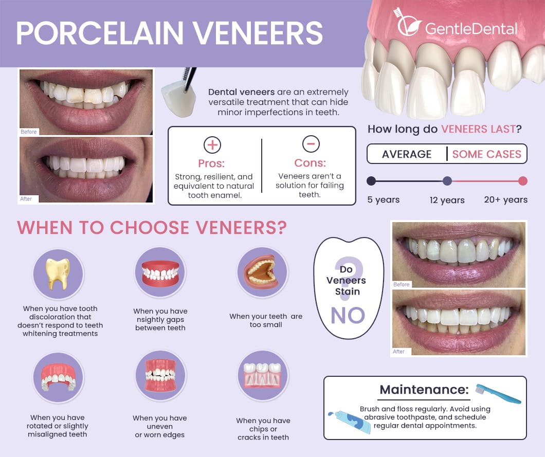 Porcelain Veneers.jpg