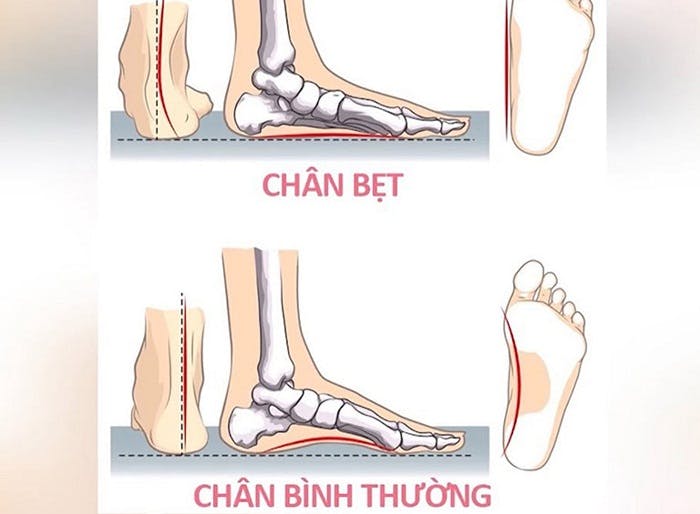 chan-doan-ban-chan-bet.jpg