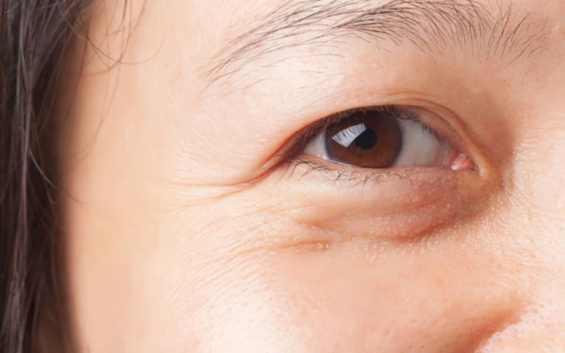 sụp mí mắt là gì