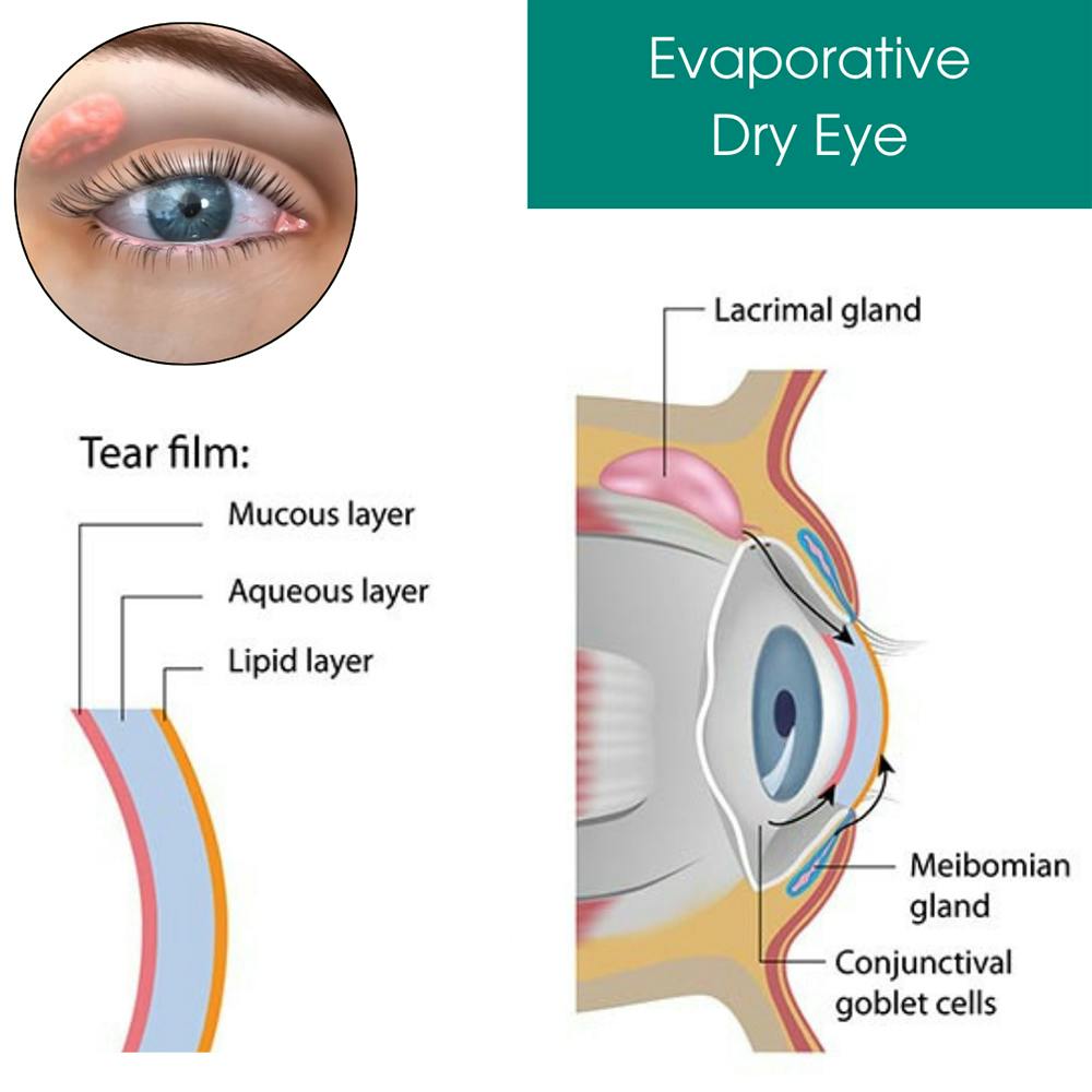 evaporative-dry-eye.jpg
