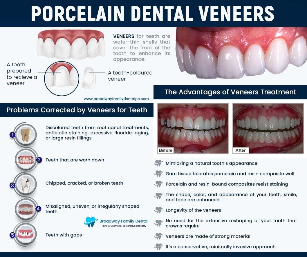 Porcelain Dental Veneers.jpg