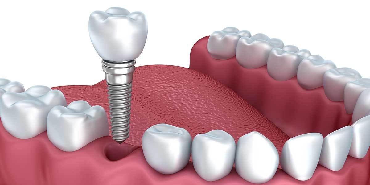 Single-Implant-Graphic.jpg