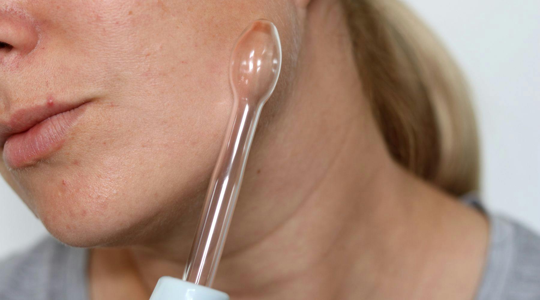 High Frequency Acne Wand_ Do They Really Work-min.jpg