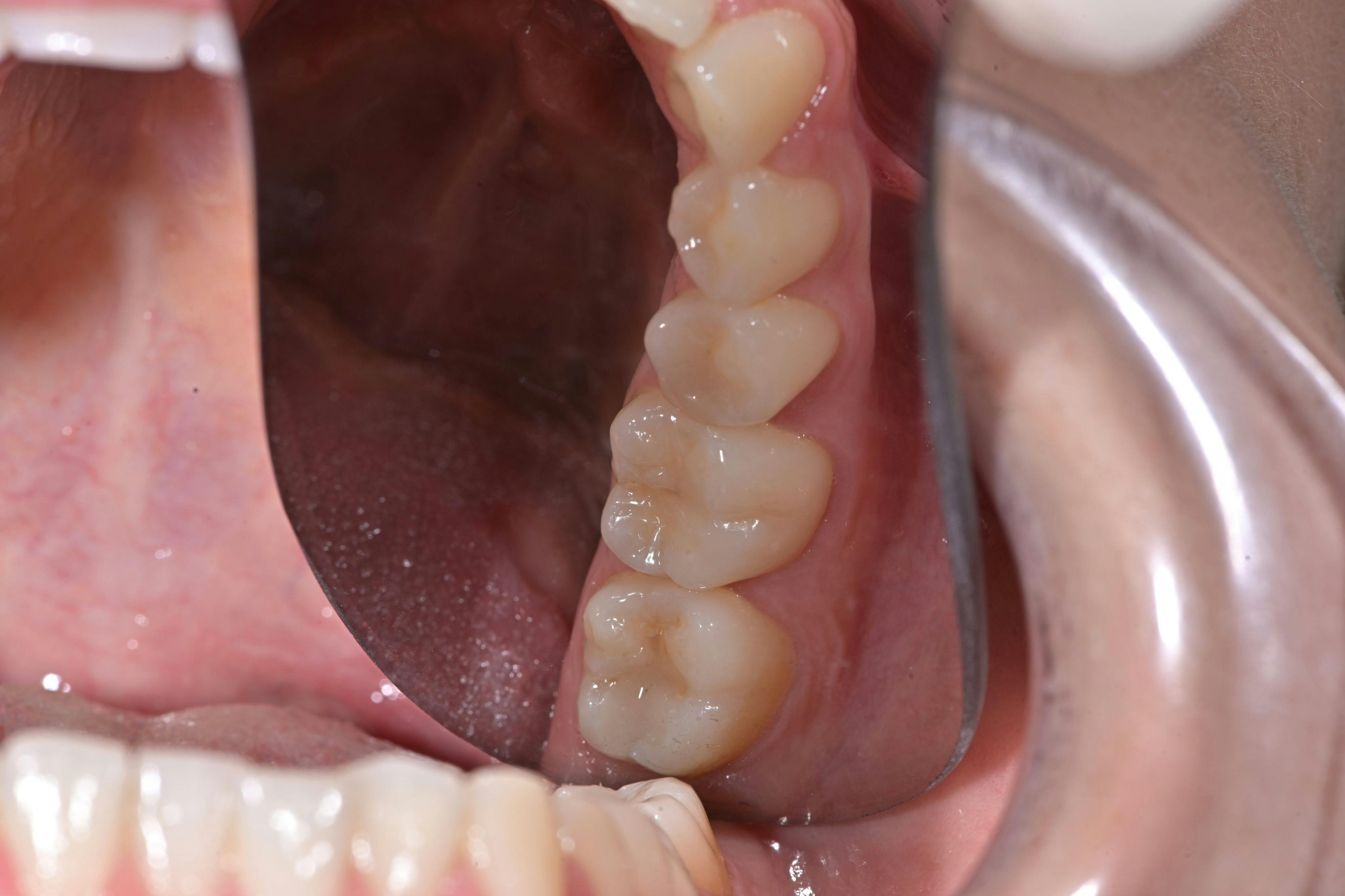Posterior lower left occlusal