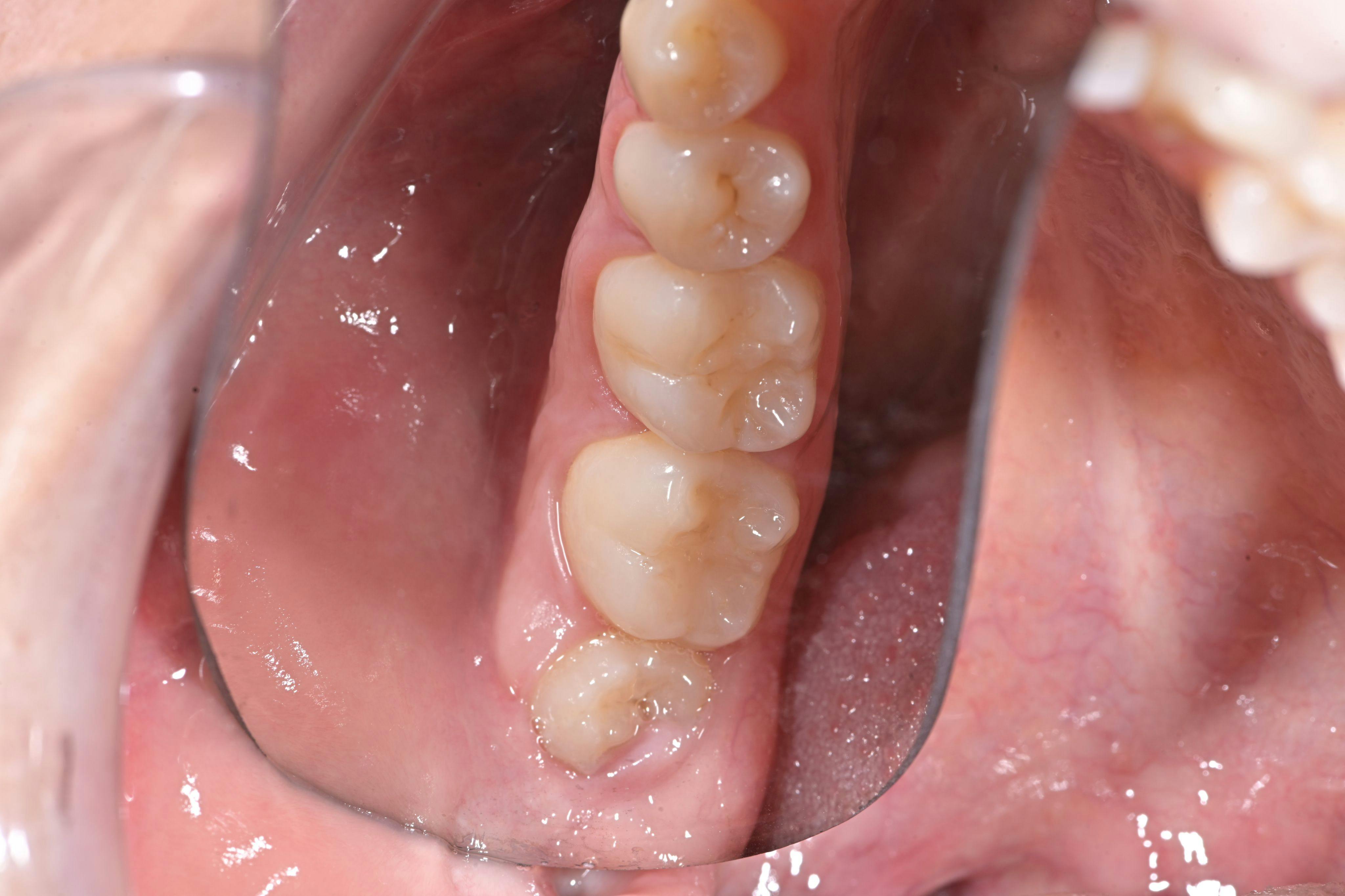 Posterior lower right occlusal