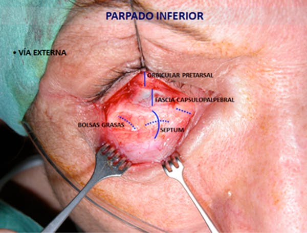 parpado inferior .jpg