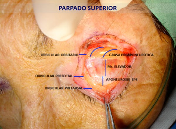 BLEFAROPLAS.jpg