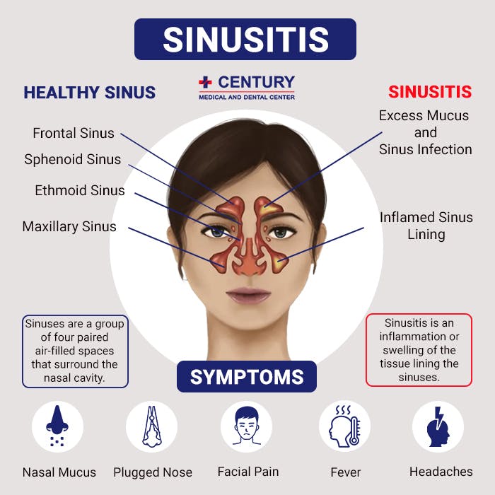Sinusitis.jpg