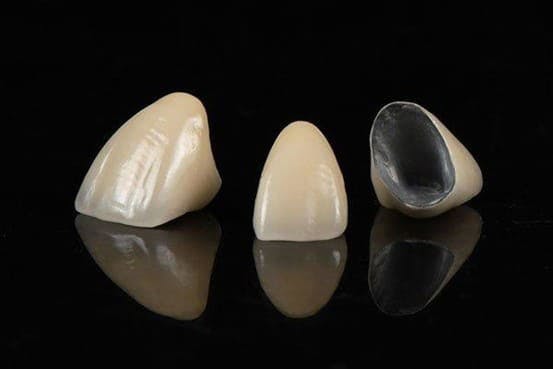 giá răng sứ thường