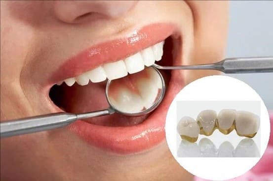bọc răng sứ kim loại