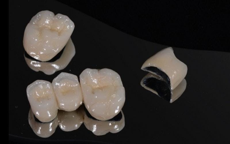 Răng sứ Titan có màu sắc khá giống răng thật