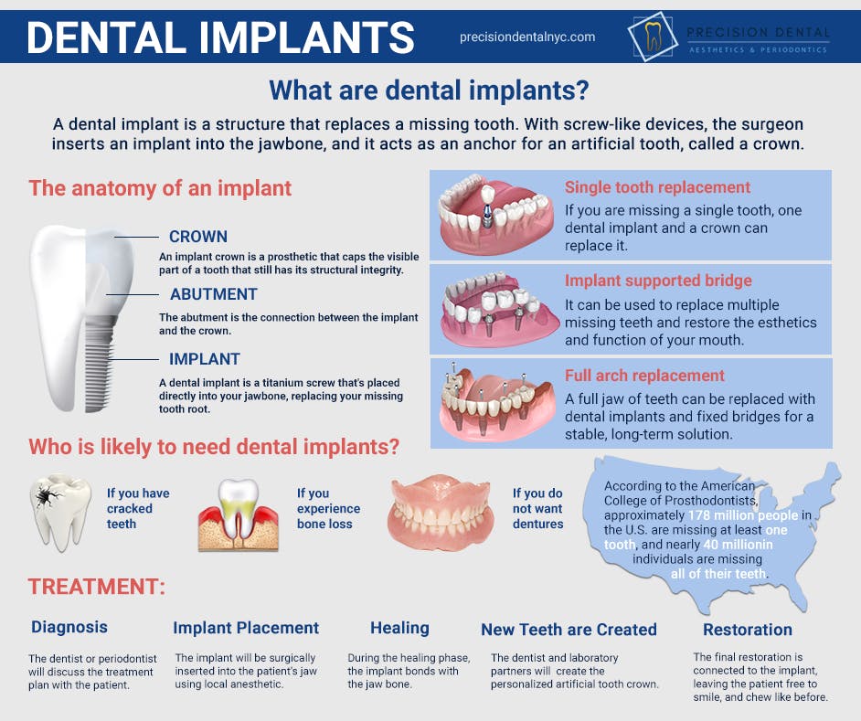 Dental Implants jpg.jpg