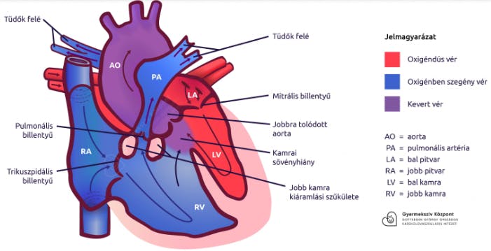 Fallot tetralogia.png