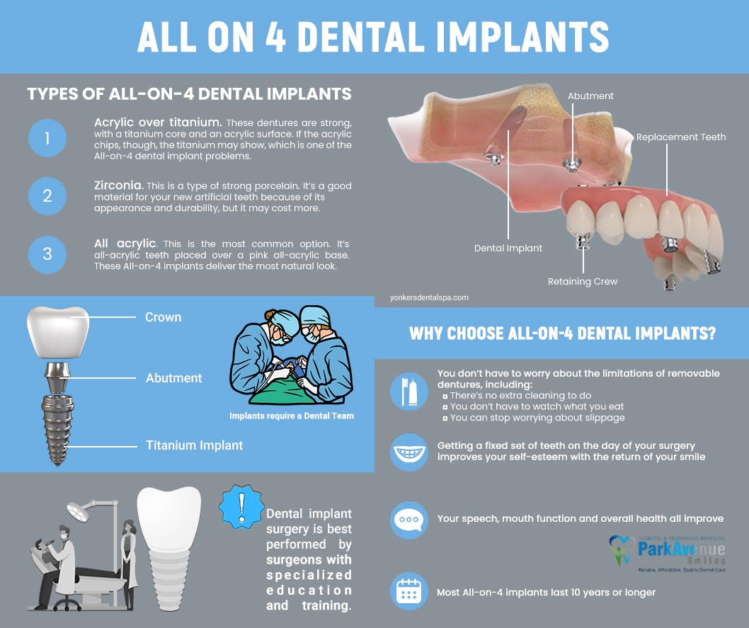 All On 4 Dental Implants.jpg