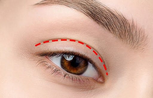 Có nên cắt mí không