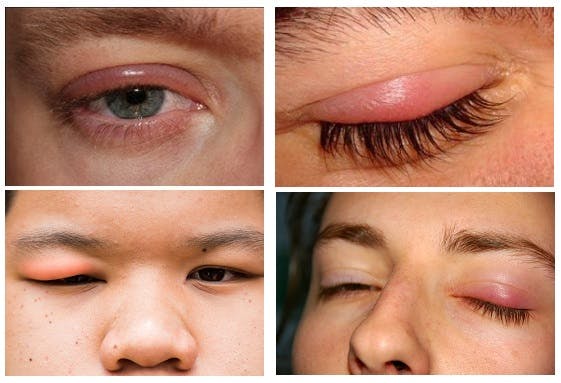 Rủi ro khi cắt mí