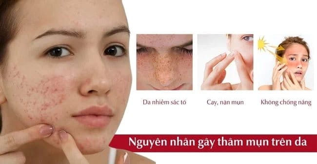cach-tri-tham-mun-new-2.jpg