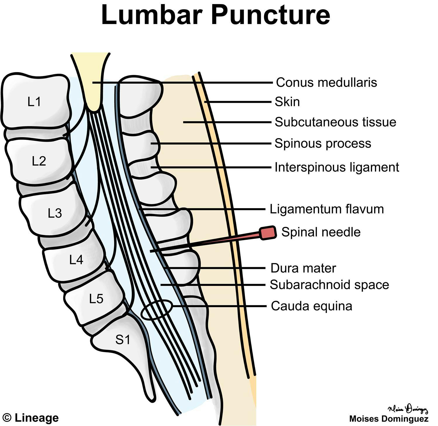 07042017mdstep1neurolumbarpuncture.jpg