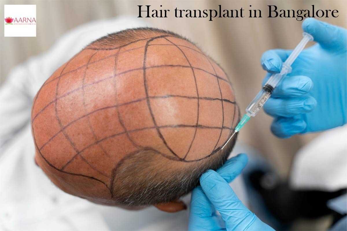 Hair transplant treatment.jpg