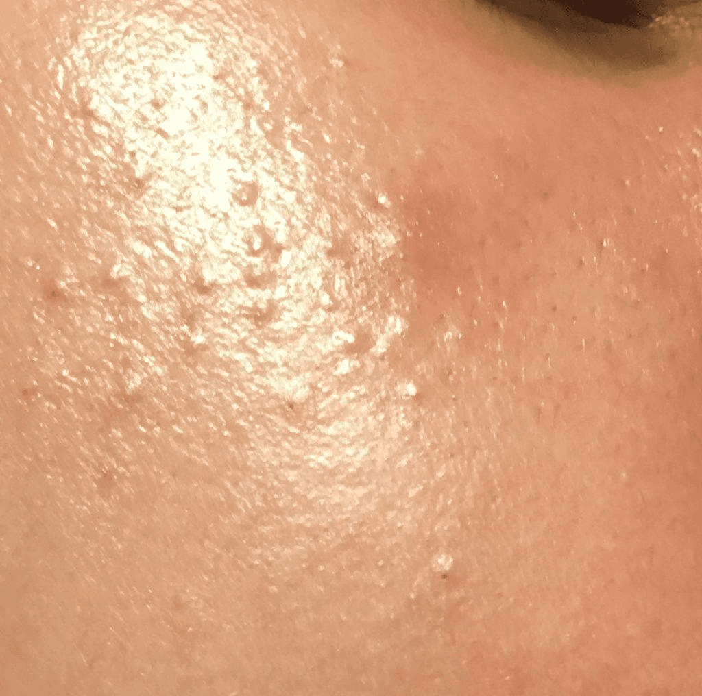 Nguyên nhân gây mụn ẩn