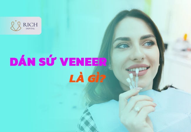 dan-su-veneer-la-gi-1.png