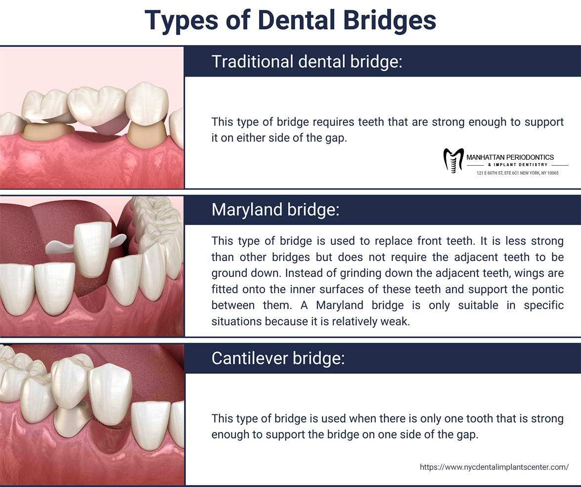 types-of-dental-bridges.jpg