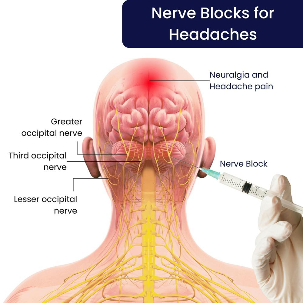 nerve-block-for-headaches-in-Brooklyn.jpg
