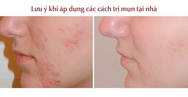 cach-tri-mun-14.jpg