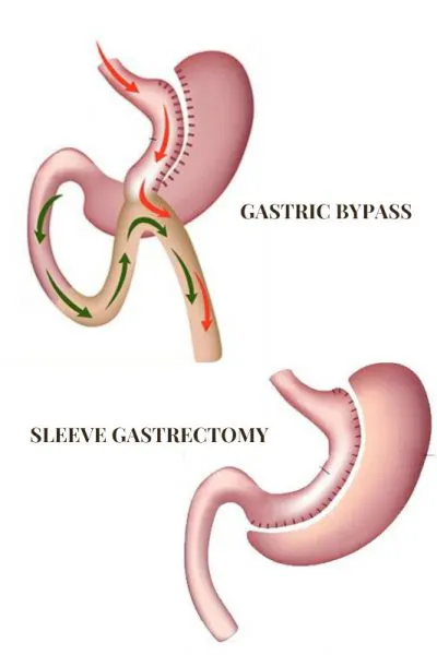 Best Bariatric Surgeon.jpg