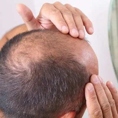 Hair-Loss-Treatment-Islamabad-Pakistan-ezgif.com-webp-to-jpg-converter.jpg