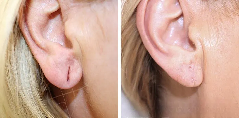 Earlobe Correction in islamabad.jpg