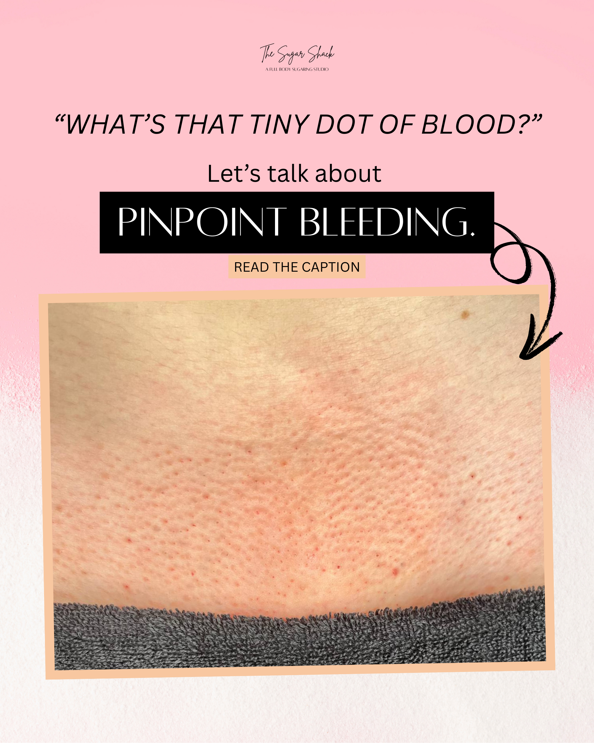 What’s that tiny dot of blood” 👀 Let’s talk about pinpoint bleeding..png