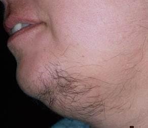 chin hirsutism.jpeg