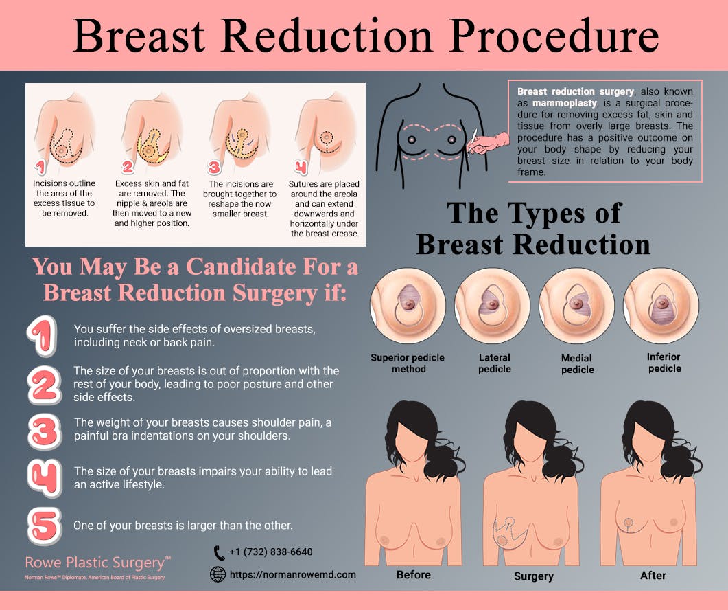 Breast Reduction Procedure.jpg