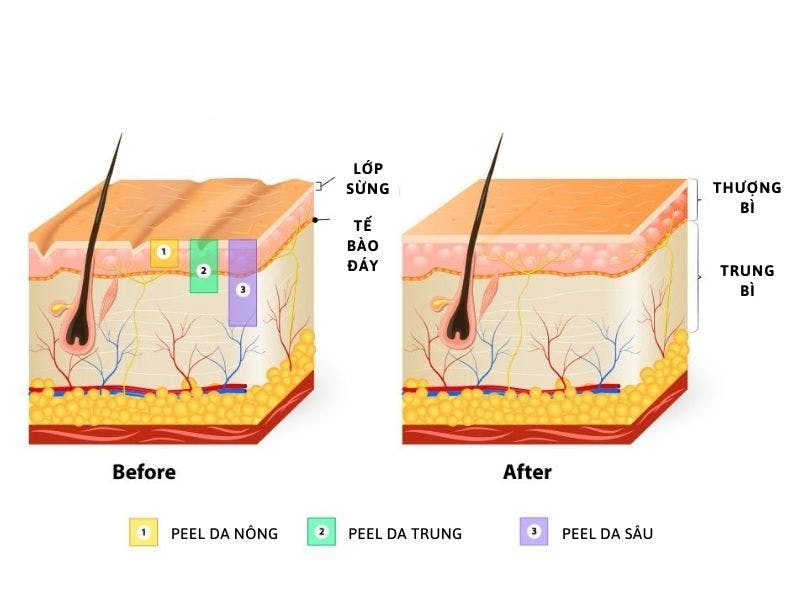 Các cấp độ peel da