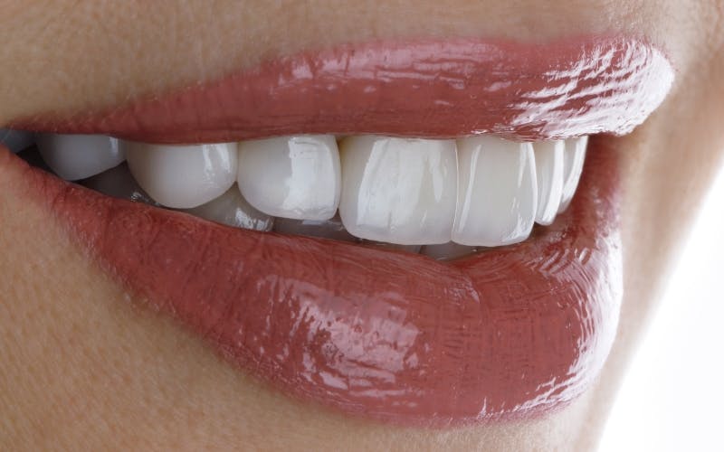 Bọc răng sứ giúp khắc phục các khuyết điểm trên răng