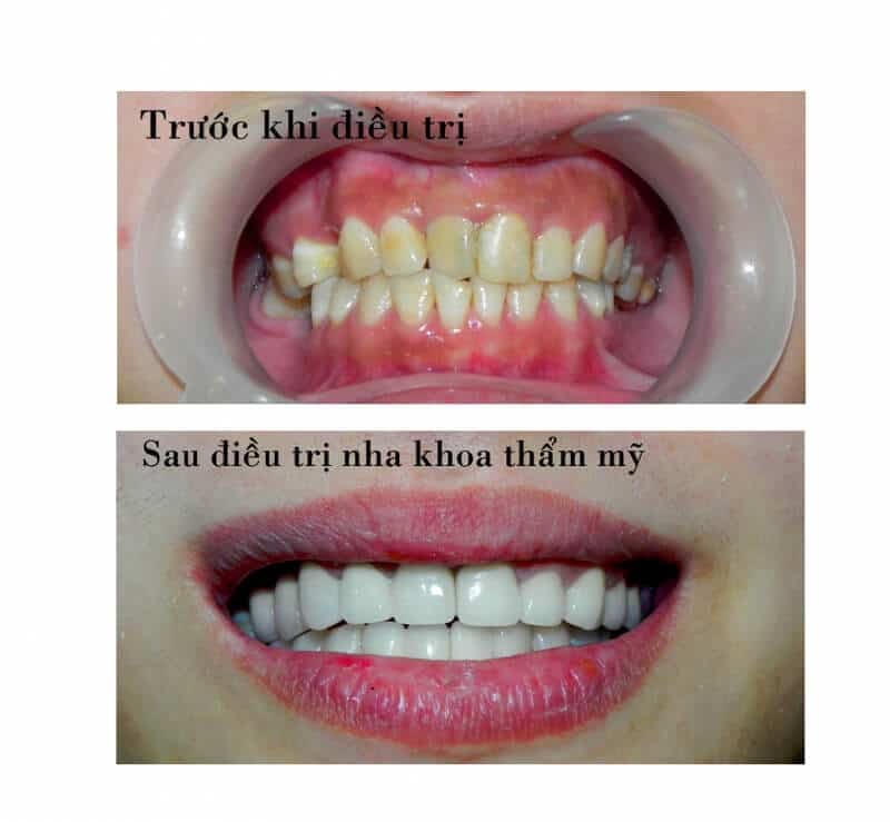 Tẩy trắng răng Đà Nẵng