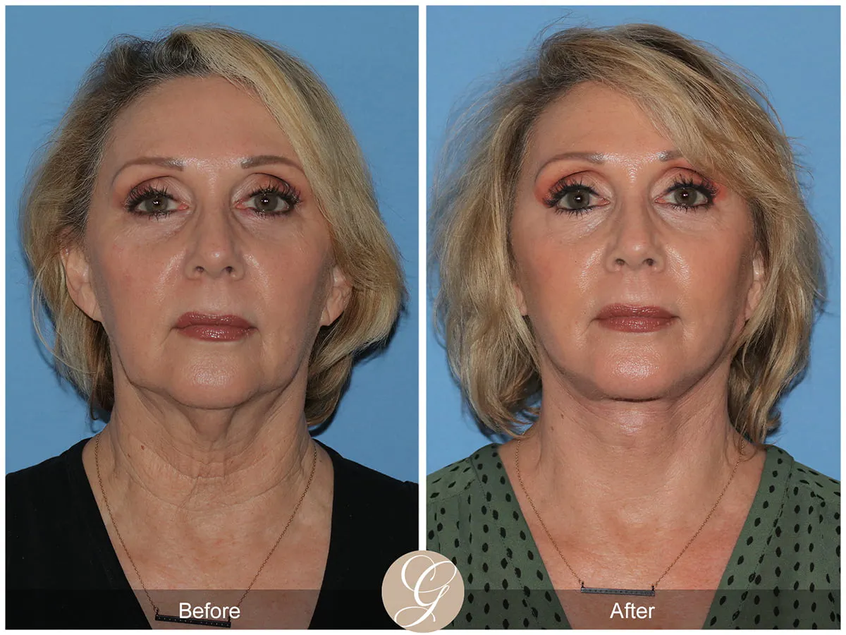 Deep plane necklift Before & After Image